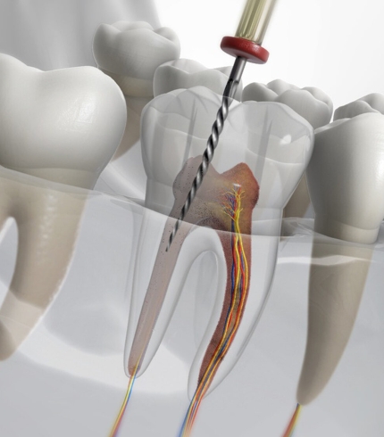 Kanal Tedavisi (Endodonti)