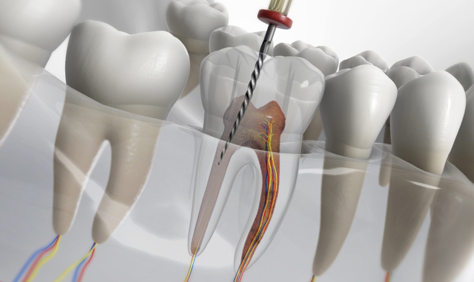 Kanal Tedavisi (Endodonti)