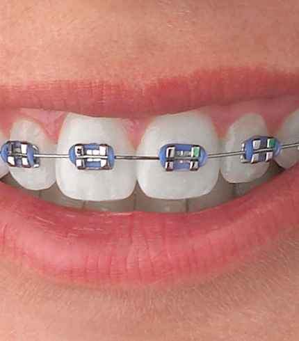 Metal Braket